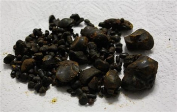 safra kesesi temizliği Nasıl Yapılır?